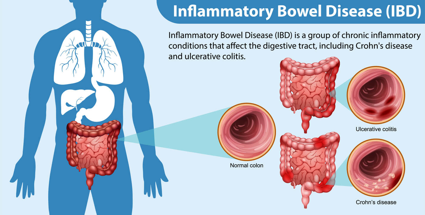 بیماری التهابی رودهinflammatory bowel disease (IBD) چیست؟